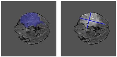 Weakly supervised pre-training for brain tumor segmentation using principal axis measurements of tumor burden